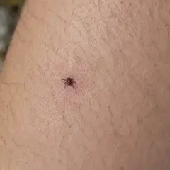 Una garrapata adherida a la piel. Aprende cómo quitar una garrapata correctamente para evitar infecciones.