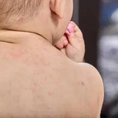 Bebé con sarpullido en la espalda, posible síntoma de meningitis.