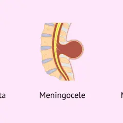 Ilustración de espina bífida en bebés: oculta, meningocele y mielomeningocele.