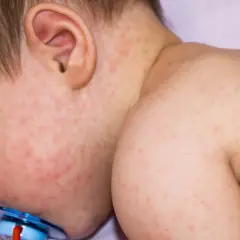 Bebé con erupción cutánea roja y fiebre, indicando que la alergia puede dar fiebre.