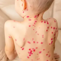 Niño con erupciones rojas en la espalda, mostrando las etapas de la varicela.