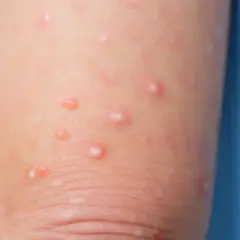 Piel de un niño con moluscos contagiosos, pequeñas protuberancias rosadas y blanquecinas que aparecen en la piel.