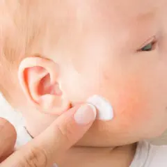 Dedo aplica crema en mejilla de bebé con enrojecimiento, posible impétigo.