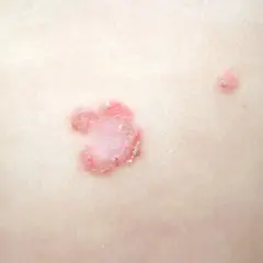 Lesiones cutáneas rojizas y escamosas en la piel de niños, indicativas de impétigo.