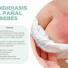 Bebé con enrojecimiento e irritación en la zona del pañal, indicativo de candidiasis del pañal.
