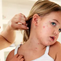 Niña con sarpullido por fiebre en la cara y cuello. Una mujer le aparta el pelo.