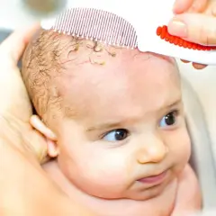Bebé con dermatitis seborreica en la cabeza, siendo peinado suavemente con un peine especial para eliminar costras.