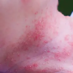 Piel enrojecida con pequeños bultos blancos y rojos en el cuello de un bebé, indicativo de sudamina.