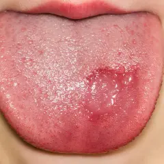 Lengua de niño con lesión rojiza y ampollas, indicativa de candidiasis oral.