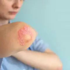 Codo con parches rojos y escamosos, indicativos de psoriasis en niños.
