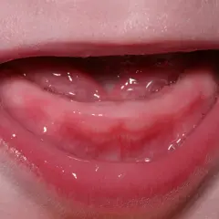 Encías rosadas y húmedas, con burbujas, listas para los primeros dientes bebé 4 meses.
