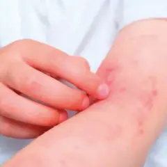 Brazo de niño con erupción roja y picazón, síntoma de dermatitis de contacto.