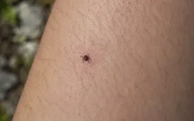 Una garrapata adherida a la piel. Aprende cómo quitar una garrapata correctamente para evitar infecciones.