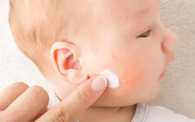 Dedo aplica crema en mejilla de bebé con enrojecimiento, posible impétigo.