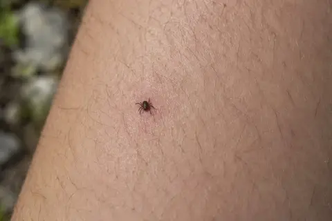 Una garrapata adherida a la piel. Aprende cómo quitar una garrapata correctamente para evitar infecciones.