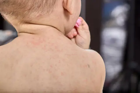 Bebé con sarpullido en la espalda, posible síntoma de meningitis.
