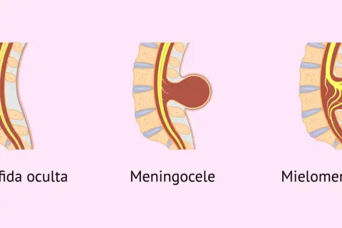 Ilustración de espina bífida en bebés: oculta, meningocele y mielomeningocele.