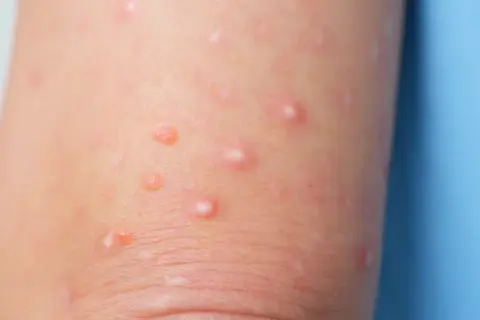 Piel de un niño con moluscos contagiosos, pequeñas protuberancias rosadas y blanquecinas que aparecen en la piel.