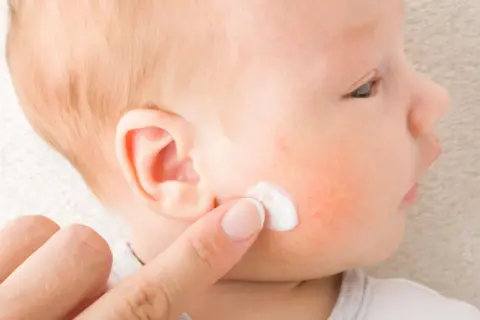 Dedo aplica crema en mejilla de bebé con enrojecimiento, posible impétigo.