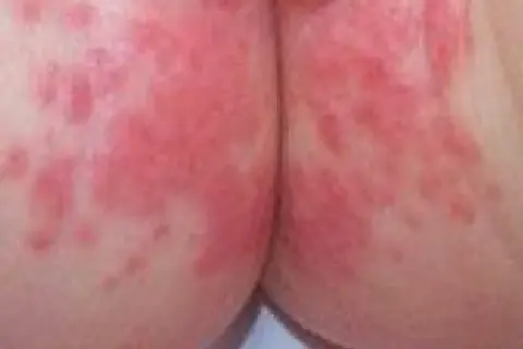 Piel irritada con enrojecimiento y pequeñas protuberancias, indicativo de dermatitis del pañal.