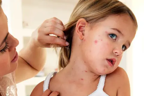 Niña con sarpullido por fiebre en la cara y cuello. Una mujer le aparta el pelo.