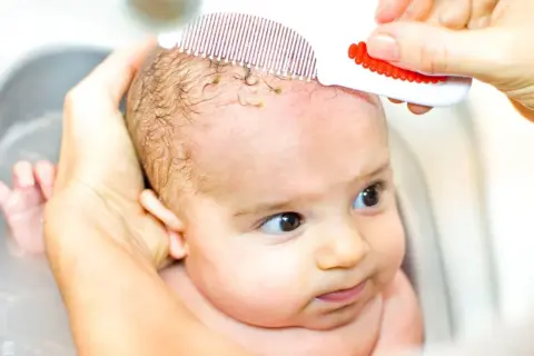 Bebé con dermatitis seborreica en la cabeza, siendo peinado suavemente con un peine especial para eliminar costras.