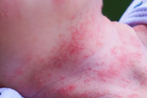 Piel enrojecida con pequeños bultos blancos y rojos en el cuello de un bebé, indicativo de sudamina.