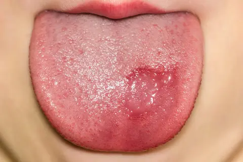 Lengua de niño con lesión rojiza y ampollas, indicativa de candidiasis oral.