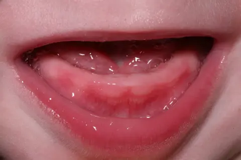 Encías rosadas y húmedas, con burbujas, listas para los primeros dientes bebé 4 meses.