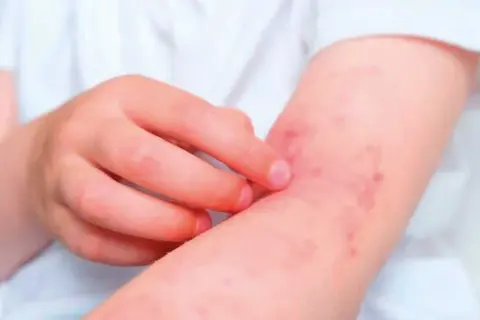 Brazo de niño con erupción roja y picazón, síntoma de dermatitis de contacto.