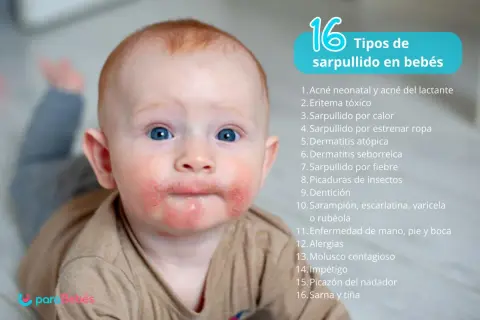 Bebé con sarpullidos en la piel alrededor de la boca y mejillas. La imagen lista 16 tipos de sarpullidos en bebés.