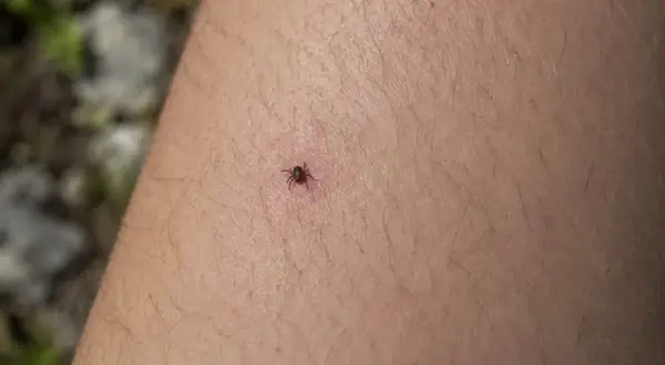 Una garrapata adherida a la piel. Aprende cómo quitar una garrapata correctamente para evitar infecciones.