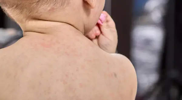 Bebé con sarpullido en la espalda, posible síntoma de meningitis.