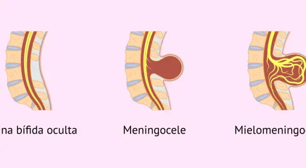 Ilustración de espina bífida en bebés: oculta, meningocele y mielomeningocele.