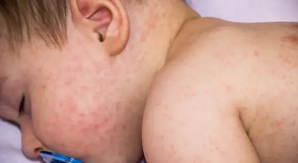 Bebé con erupción cutánea roja y fiebre, indicando que la alergia puede dar fiebre.