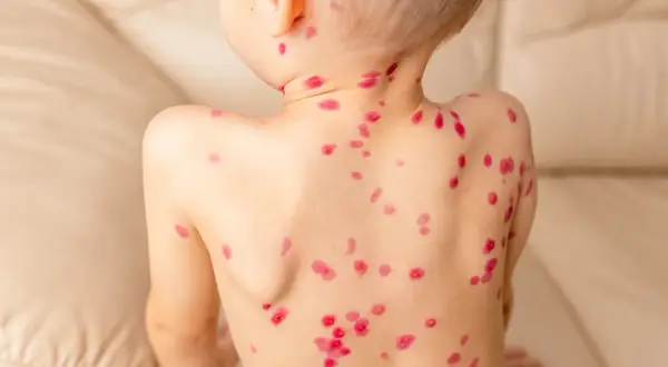 Niño con erupciones rojas en la espalda, mostrando las etapas de la varicela.