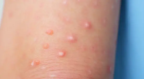 Piel de un niño con moluscos contagiosos, pequeñas protuberancias rosadas y blanquecinas que aparecen en la piel.
