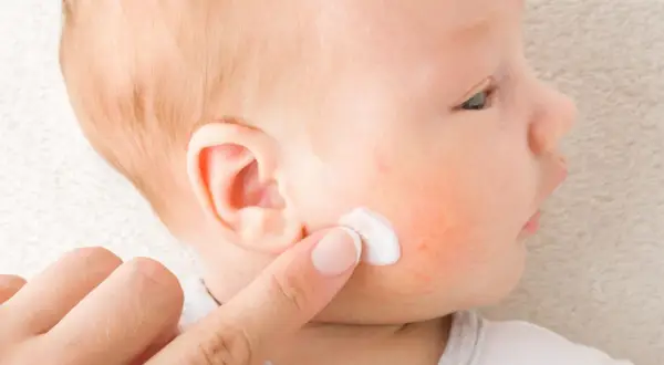 Dedo aplica crema en mejilla de bebé con enrojecimiento, posible impétigo.