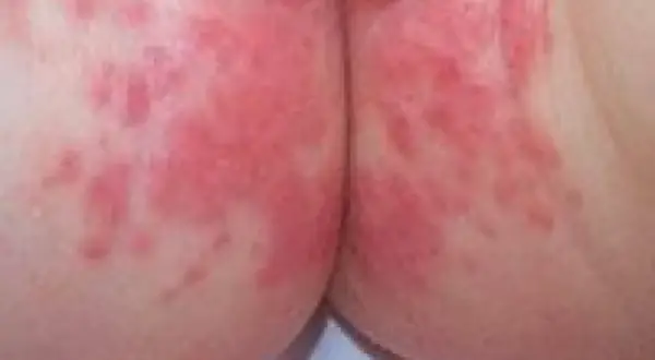 Piel irritada con enrojecimiento y pequeñas protuberancias, indicativo de dermatitis del pañal.