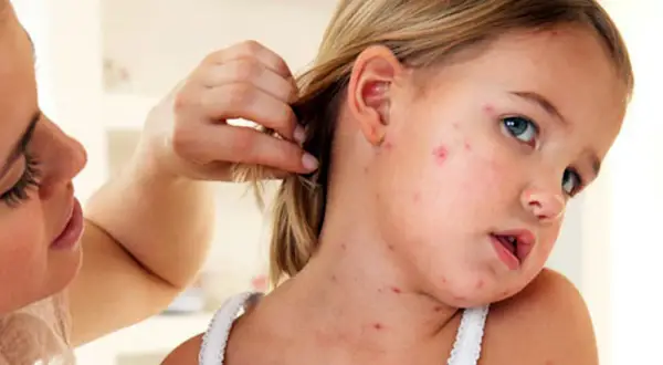 Niña con sarpullido por fiebre en la cara y cuello. Una mujer le aparta el pelo.
