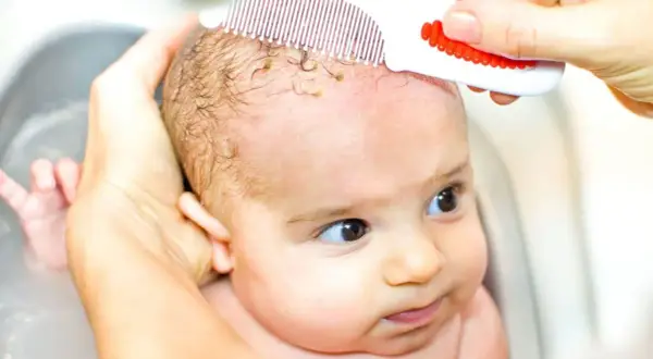 Bebé con dermatitis seborreica en la cabeza, siendo peinado suavemente con un peine especial para eliminar costras.
