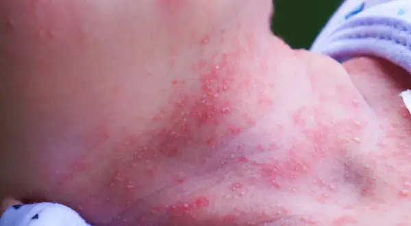 Piel enrojecida con pequeños bultos blancos y rojos en el cuello de un bebé, indicativo de sudamina.