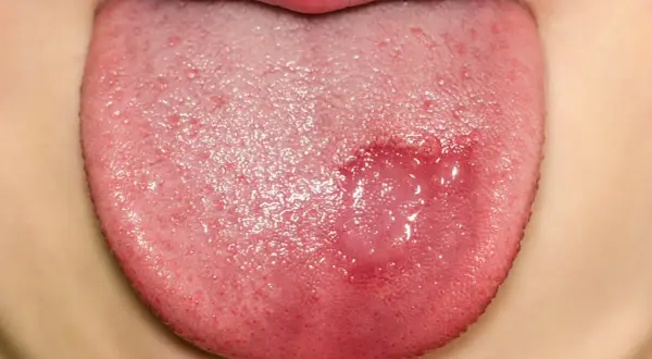Lengua de niño con lesión rojiza y ampollas, indicativa de candidiasis oral.