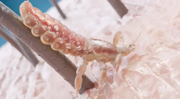 Un piojo se aferra a un cabello, mostrando su cuerpo segmentado y patas. Se aprecian detalles de su anatomía, sugiriendo la presencia de liendres.