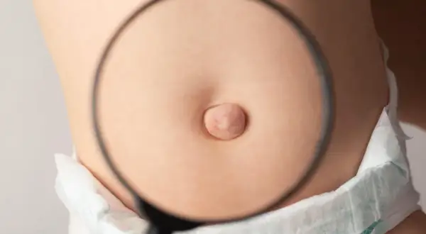Primer plano de la barriguita de un bebé con una lupa examinando una hernia umbilical.