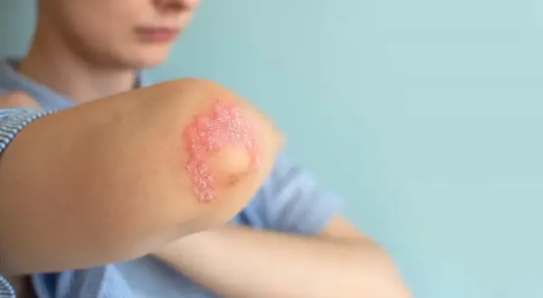 Codo con parches rojos y escamosos, indicativos de psoriasis en niños.