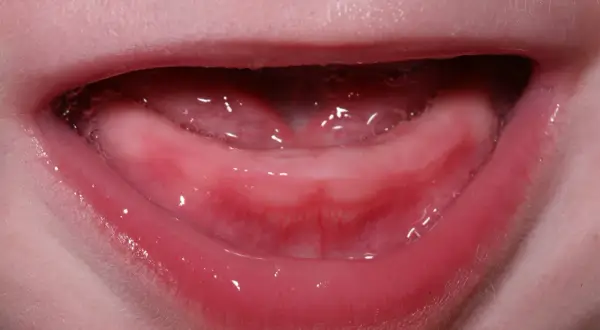 Encías rosadas y húmedas, con burbujas, listas para los primeros dientes bebé 4 meses.