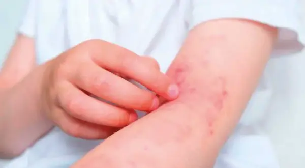 Brazo de niño con erupción roja y picazón, síntoma de dermatitis de contacto.