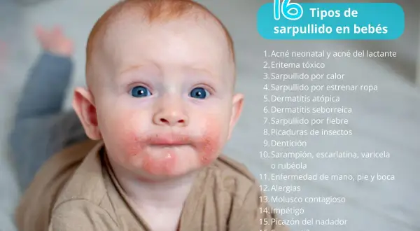 Bebé con sarpullidos en la piel alrededor de la boca y mejillas. La imagen lista 16 tipos de sarpullidos en bebés.