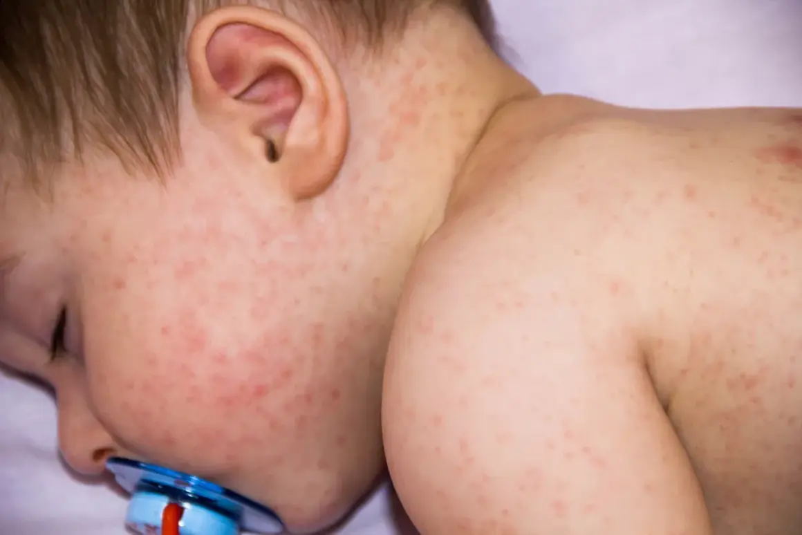 Bebé con erupción cutánea roja y fiebre, indicando que la alergia puede dar fiebre.